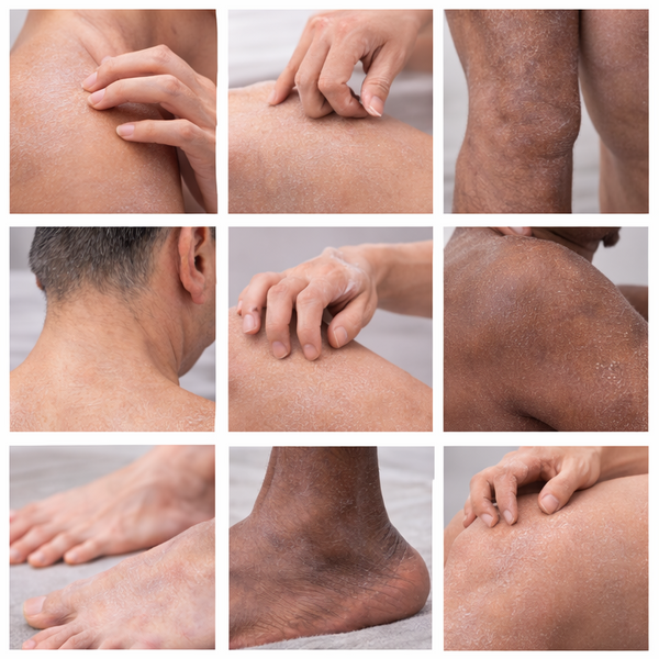 collage showing dry itchy skin on different body areas and skin tones highlighting common hard to reach problem spots
